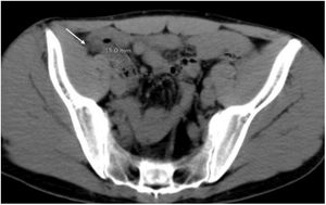 Computed tomography without intravenous contrast, axial view of the pelvis. Enlarged appendix (between markers) surrounded by hyperechoic fat (arrow).