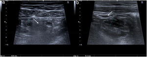 Ultrasound, axial (A) and longitudinal (B) view of the right iliac fossa. Enlarged appendix (between markers) surrounded by hyperechoic fat due to acute appendicitis (arrow). Associated reactive ganglia (arrow) can also be observed.