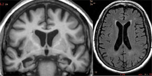 Atrophy of medial temporal predominance in a patient with Alzheimer's disease. There are few white matter lesions, which rules out the coexistence of vascular dementia (“mixed dementia”).