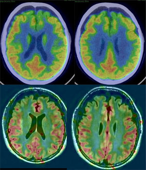 Patient with frontotemporal dementia in early stage with limited frontal atrophy. In PET (upper row) frontal hypometabolism is observed, which coincides with the area of hypoperfusion in ASL (lower row).