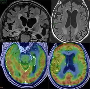Frontotemporal dementia with an atypical pattern: bilateral temporal atrophy, of left predominance, with limited frontal atrophy. In the PET/MRI fusion, temporary and also bilateral perisylvian hypometabolism is observed, without parietal involvement.