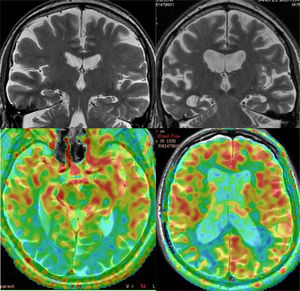 Examples of the usefulness of ASL perfusion. In the left row, patient with Lewy Body Dementia, with minimal diffuse atrophy, with marked bilateral occipital hypoperfusion. In the right row, patient with Alzheimer's disease, which presents diffuse atrophy, without clear temporal predominance, which nonetheless shows a typical pattern of parietal hypoperfusion.