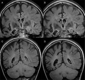 Alzheimer's disease with atypical phenotype (A and C), which presents asymmetric involvement, although with medial temporal predominance and greater parietal than frontal involvement (gradient of posterior predominance). In the annual check-up (B and D), the posterior predominance is more evident.