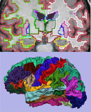 Examples of volumetry with FreeSurfer program. In the upper image, atlas-based segmentation, which delimits cortical and subcortical structures. In the image below, three-dimensional representation of the subdivision.
