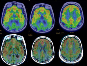 PET/MRI Fusion (upper row) and ASL Perfusion (lower row) showing posterior parietal and cingulate lobes in which hypometabolism and hypoperfusion are observed in a patient with Alzheimer's disease.