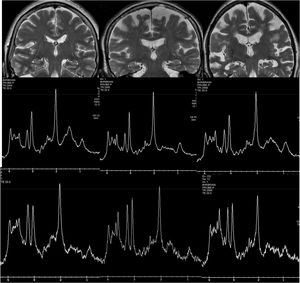 Examples of hydrogen spectroscopy located in the precuneus (central row) and the hippocampus (lower row). The left column shows a normal subject. The central column corresponds to a patient with Lewy Body Dementia and the right column to a patient with Alzheimer's disease. The increase in Mi and the decrease in NAA are more prominent in the hippocampus, although the spectrum quality is lower.