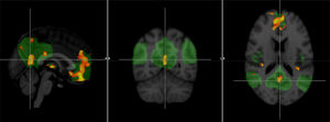 Comparison of a group of patients with Alzheimer's disease and a healthy group with functional connectivity value in the default network obtained by resting-state functional magnetic resonance imaging. The areas in orange correspond to significant decrease (p<0.001) in the group with Alzheimer's disease.
