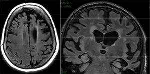 Frontotemporal dementia. Axial and coronal FLAIR cuts in which frontal and temporal atrophy of left predominance is observed. Temporary atrophy does not show medial predominance. There is a discrete increase in size in the temporal and frontal white matter.