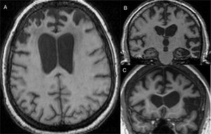 Patterns of focal atrophy in various forms of frontotemporal dementia. (A) behavioural form with atrophy in frontal poles. (B) semantic form with atrophy of left temporal predominance. (C) logopenic shape with left perisylvian atrophy.