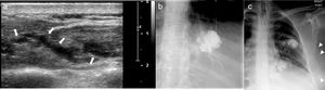 41-Year-old female with venous malformations involving the left-sided chest wall. Ultrasound image (a) reveals a heterogenous subcutaneous lesion containing predominantly anechoic vascular channels (arrows). Image obtained with direct percutaneous injection of contrast material (b) shows diffuse homogeneous enhancement of the lesion. Multiple phlebolites are noted along the left sided chest wall on a post percutaneous contrast image (arrows).