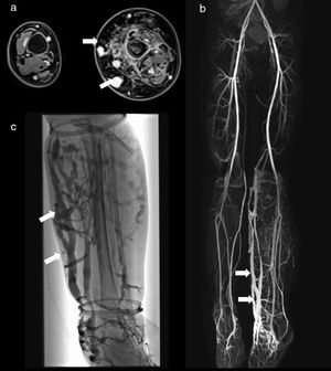 5-Year-old male with Klippel–Trenaunay syndrome and hemihypertrophy of the left lower extremity presented with extensive subcutaneous and intramuscular venous malformations of the left calf and distal thigh. Axial delayed post-contrast fat-suppressed 3D VIBE image (a) shows the enhancing venous malformations as well as the left-sided hemihypertrophy with significant fatty overgrowth. Varicose draining veins (arrows) are demonstrated on this image (a) as well as on the coronal venous phase MRA (MIP reconstruction) (b) and venogram (c).