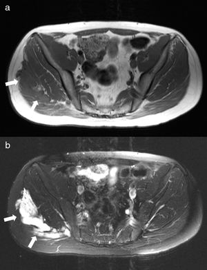Right gluteal venous malformation. Axial T1-weighted image (a) shows a hypointense lobulated mass involving the right gluteal area (arrows). On axial STIR image (b), the venous malformation is hyperintense and has a multilocular appearance due to abnormal venous lakes separated by thin hypointense septa.