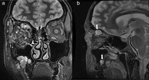 32-Year-old women with macrocystic lymphatic malformation involving the right orbit and right maxillary sinus. Coronal (a) and sagittal T2-weighted images (b) show a multicystic lesion (*) with several internal fluid–fluid levels (arrows) due to hemorrhage. Lack of enhancement was demonstrated on post-contrast imaging (not shown).