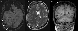 17-Year-old female with Surge–Weber syndrome. Susceptibility weighted image (a) shows atrophy and cortical mineralization involving the sulcus of the right parietal-temporal occipital convexity (arrows), reflecting low vascular malformations in the pia mater. Marked right calvarial thickening is seen on axial T2-weighted (b) and coronal T1-weighted (c) images. Facial capillary malformation was present on clinical exam.