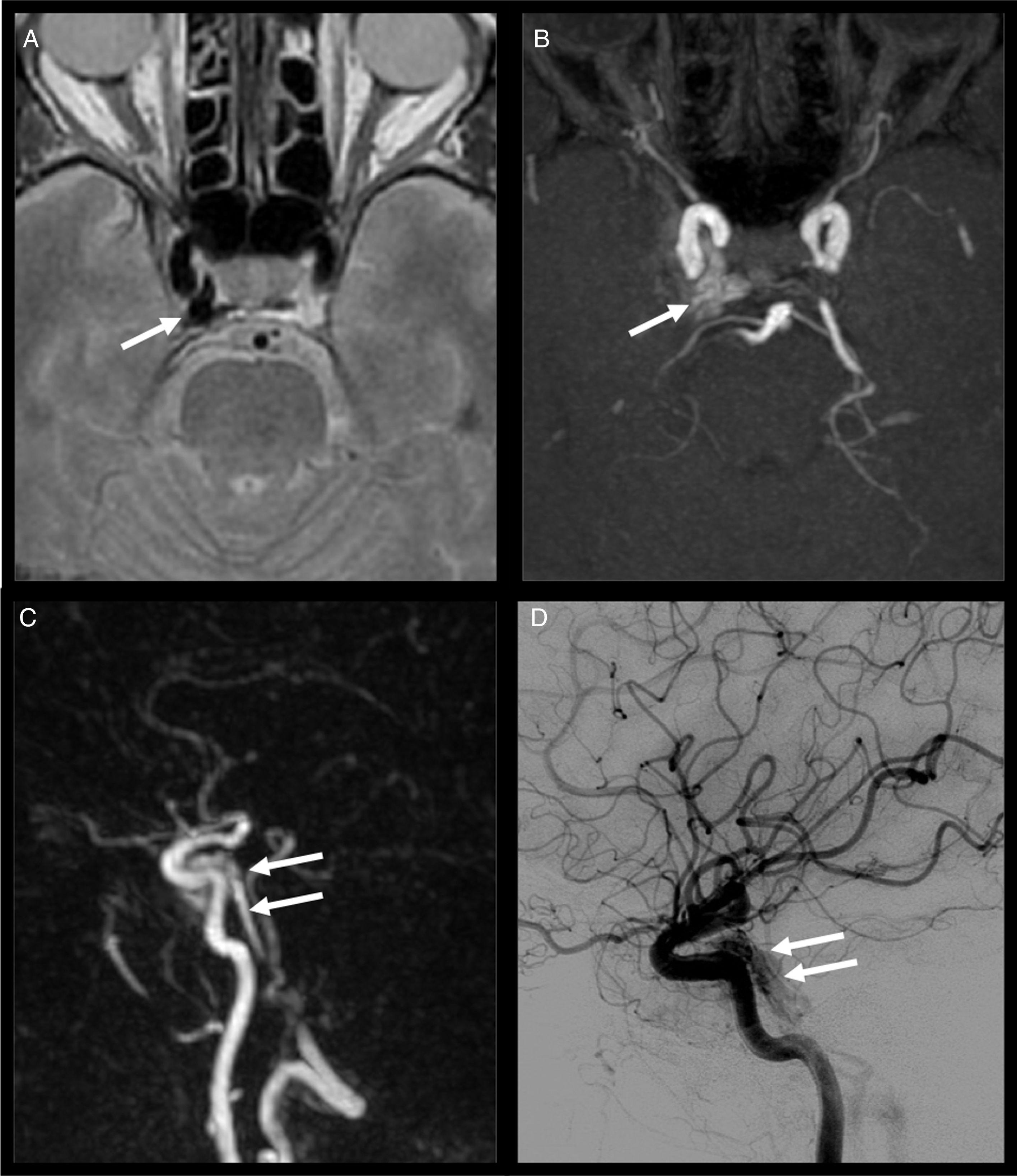 Palbebral Injection Cranial nerve disorders: Clinical manifestations and topography ...