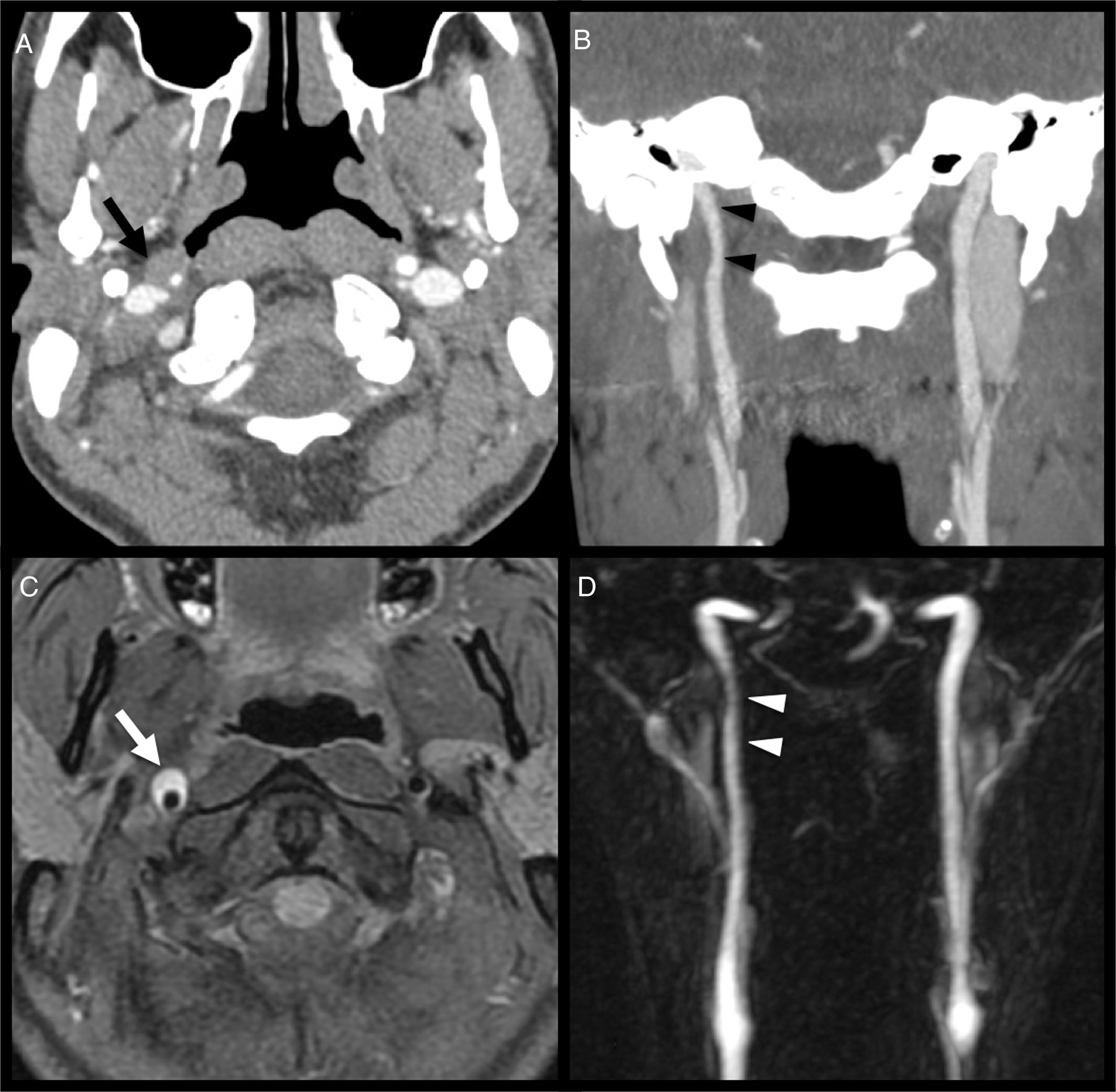 Fat Dissection Cranial nerve disorders: Clinical manifestations and topography ...