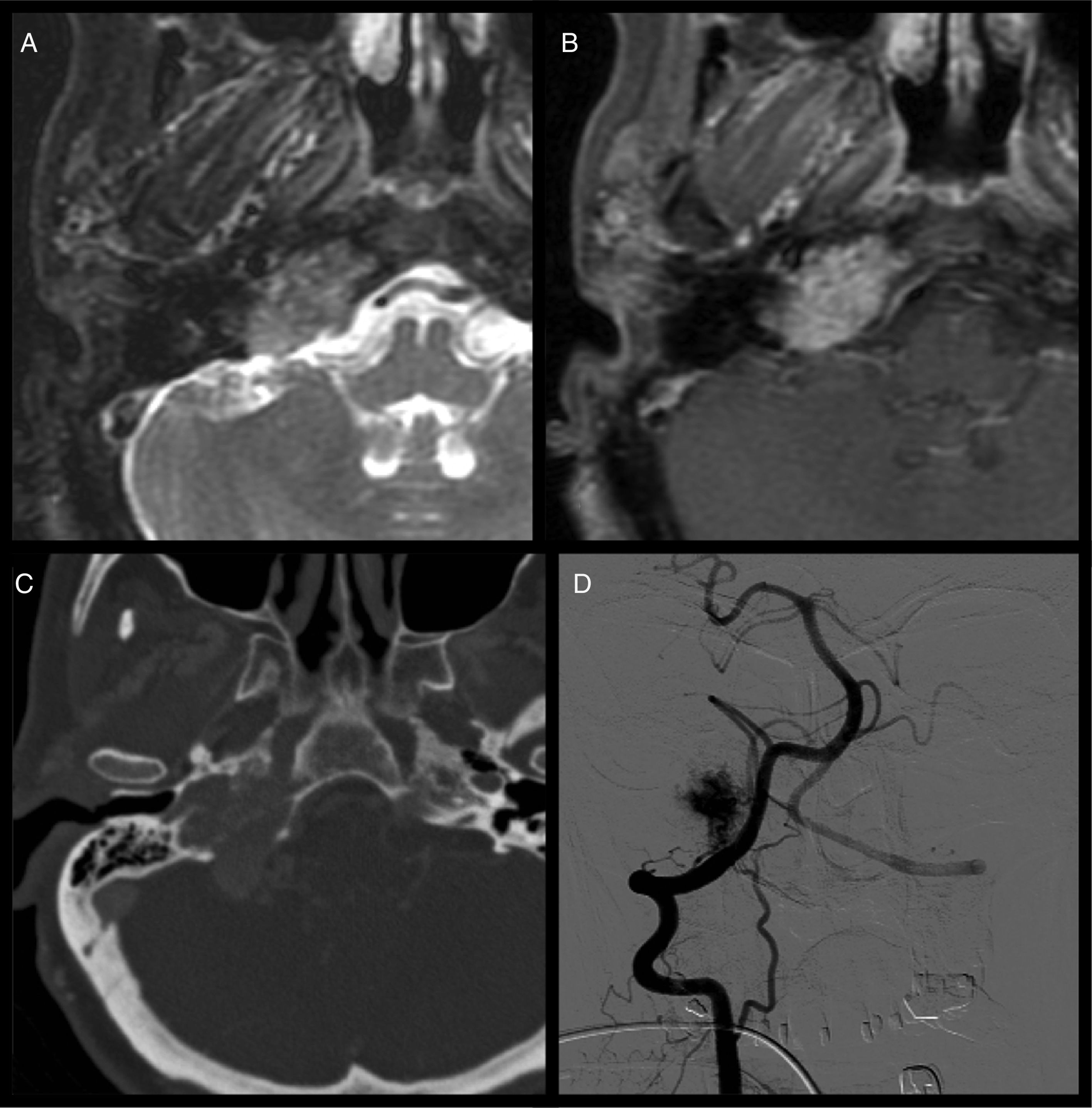 Phelp Sign Radiology Cranial nerve disorders: Clinical manifestations and topography ...