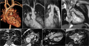 Post-operative changes in great vessels following arterial switch+LeCompte. Posterior ascending aorta. The pulmonary arteries wrap around the suprasinus ascending aorta. (A) Thoracic angio-MRI, 3D reconstruction, anterior view. (B) Oblique coronal maximum intensity projection (MIP). Ascending aorta sinus dilation. Pulmonary arteries on the sides. (C) Oblique sagittal MIP. Sinus dilation. Post-coarctation repair aneurysm in a fusiform pattern. (D) 3C long axis GE. Relationship of major vessels to outflow tracts. (E) Black blood axial SE. Typical image of pulmonary arteries and ascending aorta. (F) Short axis GE. Relationship between ascending aorta/systemic outflow tract and pulmonary artery. Stenosis in systemic atrial mesh (arrow). (G and H) 4-C GE, left ventricle (systemic) outflow tract and right ventricle (pulmonary) outflow tract. AO: aorta; aAO: ascending aorta; dAO: descending aorta; LPA: left pulmonary artery; PA: pulmonary artery; PV: pulmonary ventricle; RPA: right pulmonary artery; SVC: superior vena cava; SV: systemic ventricle.