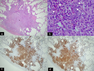 Panoramic histological image stained with haematoxylin–eosin (H–E 2.5×). (a) Spiculated nodule (asterisk) with irregular borders adjacent to a bronchus. This dense cellular aggregate is composed mainly of Langerhans cells and some eosinophils. (b) Higher magnification histological image (H–E 20×) showing infiltrates of Langerhans cells (arrows), characterised by their large size, oval shape, kidney-shaped nucleus and granular inclusion bodies (Birbeck granules) which are accompanied by eosinophilic infiltration (arrowheads). (c) Immunohistochemical staining for CD-1a (2.5×) and S-100 (2.5×). (d) Image showing extensive and intense cytoplasmic positivity in the Langerhans cells which confirms the diagnosis of Langerhans cell histiocytosis (same patient as in Fig. 5).