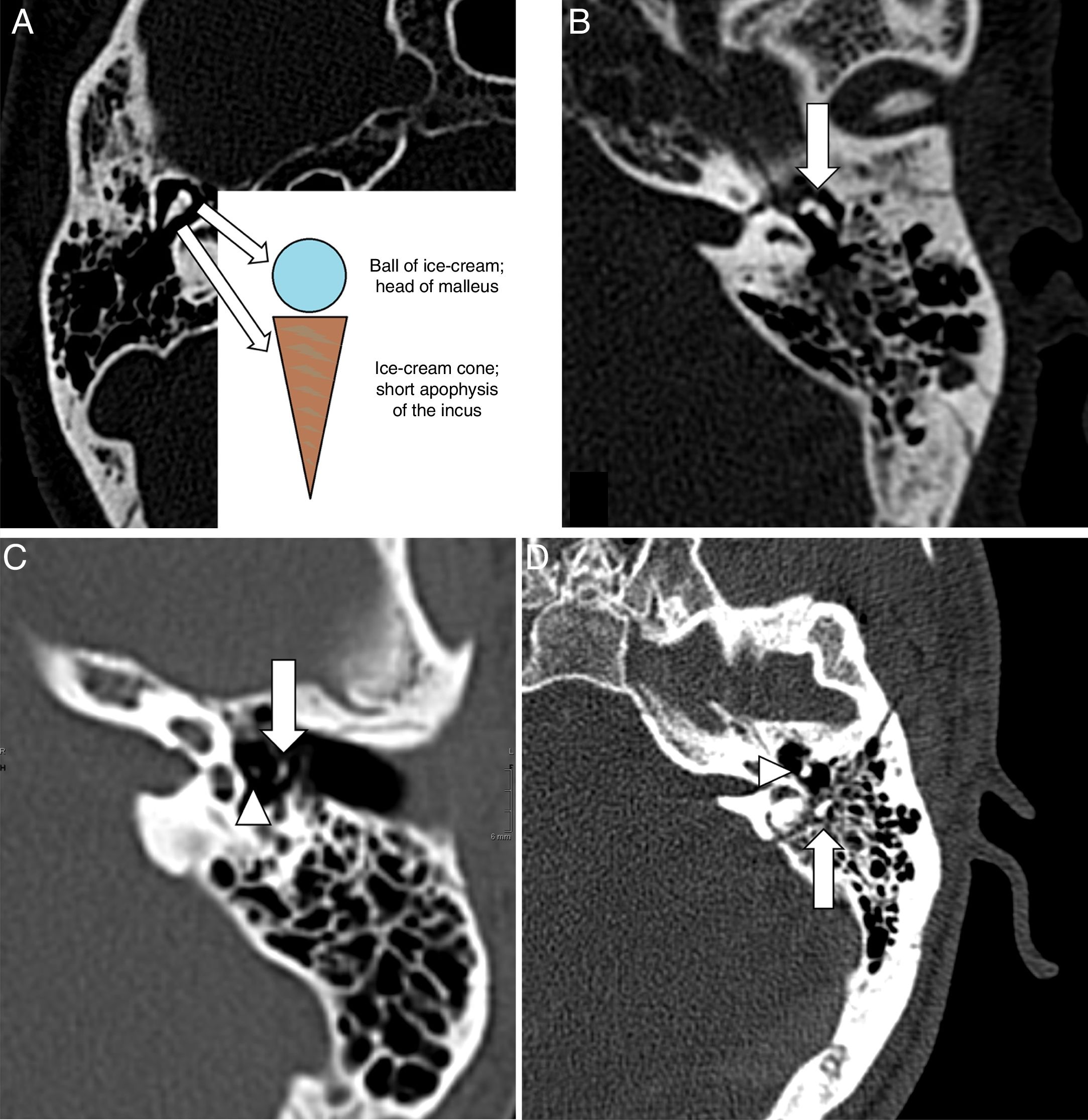 Traumatic Injury Of The Petrous Part Of The Temporal Bone Keys For traumatic-injury-of-the-petrous-part-of-the-temporal-bone-keys-for