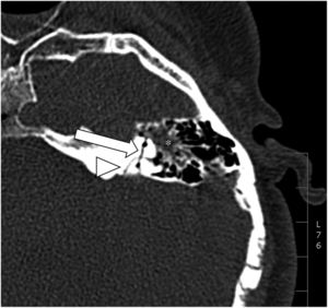 Axial CT with fracture involving the otic capsule; in this case, the superior semicircular canal (arrow). The image shows how the fracture line crosses the petromastoid canal (arrowhead), an important “pitfall” to take into account. Occupation of mastoid cells (*).