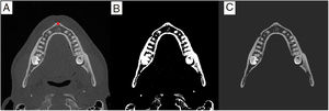 Automatic segmentation of the jaw. (A) Original computed tomography image with automatically selected seed point. (B) Binary image after applying Otsu thresholding, with the mask corresponding to high densities. (C) Entire segmented mandible.