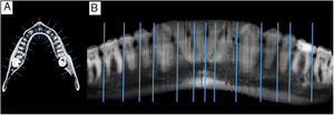 Orthopantomographic angular reconstruction. (A) Definition of the spline-type line with nine reference points and example of some perpendicular sections. (B) Angular reconstruction as a maximum intensity projection of the sections perpendicular to the curve of the arch. Also shown is an example of reference lines that separate the sections of bone associated with each tooth space.