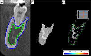 Trabecular analysis. (A) Section of the mandible perpendicular to the line of the arch, in which the segmentation of the cortex (blue) and cancellous bone (green) of the mandible can be seen. (B) Section containing only cancellous bone. (C) Binarised image showing the trabecular bone (grey) with the structural line of the skeleton overlaid, colour-coded according to the trabecular thickness (in millimetres). The detail indicates that for each central point of the skeleton the distance to the edge of the trabecula is measured. The trabecular separation is obtained analogously, taking the structural line of the bone marrow, i.e. the image complementary to that of the trabecular bone.
