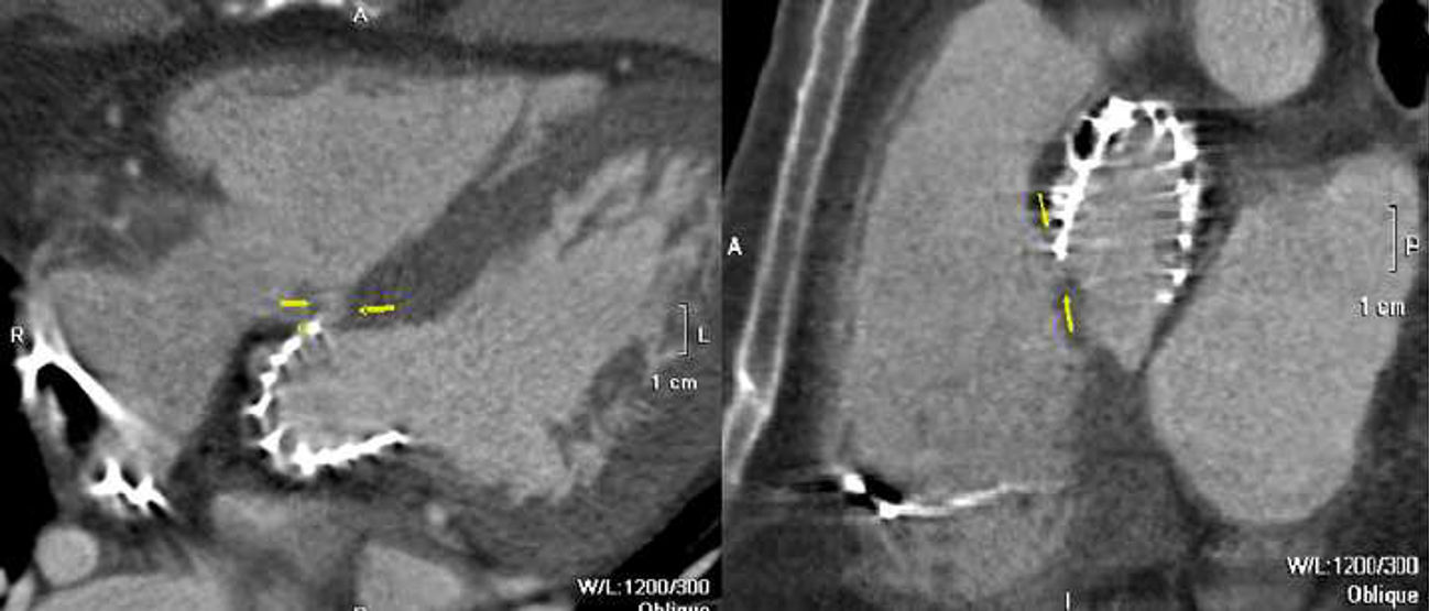 Aortic Root Rupture Mouse Aortic root rupture and acquired intracardiac shunt after transcatheter ...