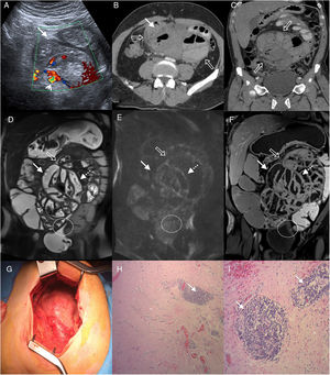 55-Year-old man examined due to intermittent abdominal pain and abdominal distension, with no relevant clinical history. (A) Doppler ultrasound, cross section of the abdomen showing grouped small intestine loops (white arrow) with mural thickening and signs of increased parietal flow (arrowhead). Multidetector computed tomography (MDCT) with intravenous contrast (B), cross section (C) and oblique coronal reconstruction, showing central abdominal conglomerate of dilated small intestine loops with moderately thickened walls and “encapsulated” by a thickened peritoneal membrane (hollow arrows). MR enterography with contrast, coronal sections (D) TSE T2 sequence (E), diffusion b 800 (F) and VIBE T1 sequence with fat saturation after administration of gadolinium (portal phase), which reveal parietal thickening with decreased folds (white arrows) of the loops encapsulated by the thickened peritoneal membrane (hollow arrows) and surrounding laminar fluid. Signs of restriction in diffusion and enhancement with contrast in the walls and the peritoneal membrane (dotted arrows), findings related to inflammatory changes and fibrosis. Note the retraction of the bladder roof in the area of contact with the peritoneal surface (circle). (G) Intraoperative photograph showing a thick membrane that encapsulates the small intestine. Histology of the peritoneum with haematoxylin–eosin 40× (H) and 100× (I) showing fibrosis with dense collagen fibres (asterisk) and chronic inflammation by lymphocyte infiltration and perivascular plasma cells (arrows).