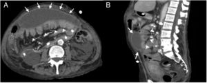A 57-year-old woman was examined due to repeated intestinal obstruction, with a history of chronic kidney disease and peritoneal dialysis. Abdominal multidetector computed tomography with intravenous contrast, portal phase, cross section (A) and sagittal reconstruction (B), where a loculated fluid collection (arrows) with a defined wall that enhances with contrast is observed. Produces a mass effect posteriorly rejecting the small intestine loops (arrow heads).