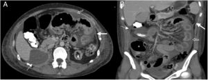 38-Year-old woman admitted for abdominal pain. History of systemic lupus erythematosus and chronic renal failure, in peritoneal dialysis. Multidetector computed tomography of the abdomen and pelvis with oral and intravenous contrast, cross section of the upper abdomen (A) and coronal reconstruction (B) where thickening and enhancement of the peritoneal surface on the left flank (white arrows), subhepatic loculated ascites (dotted arrow), free fluid between intestinal loops (hollow arrow) and distension of small intestine loops (asterisk) is observed. Bad evolution with death six months after the study.