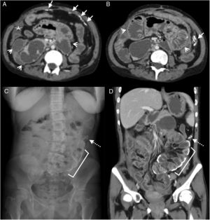 25-Year-old woman with diffuse abdominal pain. History of chronic kidney disease due to congenital nephrotic syndrome (diffuse mesangial sclerosis), in peritoneal dialysis for 10 years. Multidetector computed tomography (MDCT) with intravenous contrast, portal phase: (A) Cross section showing linear peritoneal calcifications (white arrows) and dilated sections of the small intestine (arrowheads), as well as a small subhepatic collection (star). (B) Cross section, caudal to A, showing calcifications in the form of a conglomerate in the parietal peritoneum of the left flank (white arrow) and dilation of small intestine loops (arrowheads). (C) Standing radiograph of the abdomen (anteroposterior) showing multiple linear calcifications corresponding to the intestinal wall (bracket) and peritoneum (dotted arrow). (D) MDCT, coronal reconstruction with findings similar to radiography.