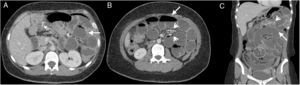 28-Year-old woman with a history of: gastric bypass one year prior, and recent appendectomy, admitted for abdominal pain in the epigastrium with irradiation to the left flank of 24h of evolution, without other associated symptoms. Multidetector computed tomography of the abdomen with intravenous contrast, portal phase, cross section (A and B) and coronal reconstruction (C) showing surgical traces of the jejuno-jejunal anastomosis in the right flank (dotted arrow), slight engorgement of the mesenteric vessels (arrowheads) and dilation of the small intestine (white arrow). At the central abdominal level, an obstruction site with a fine loop-thick loop (circle) transition is evident. Exploratory laparoscopy revealed a hernia through Petersen's space and central abdominal adhesions.