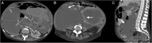 51-Year-old woman with multiple surgical interventions for pseudomyxoma peritonei. Multidetector computed tomography of the abdomen with intravenous contrast, portal phase, cross section (A and B) and sagittal reconstruction (C) where loculated low attenuation collections without enhancement (white arrows) and with calcified walls (hollow arrows) are observed. The intestinal loops are compressed and with oral contrast material inside (asterisk).