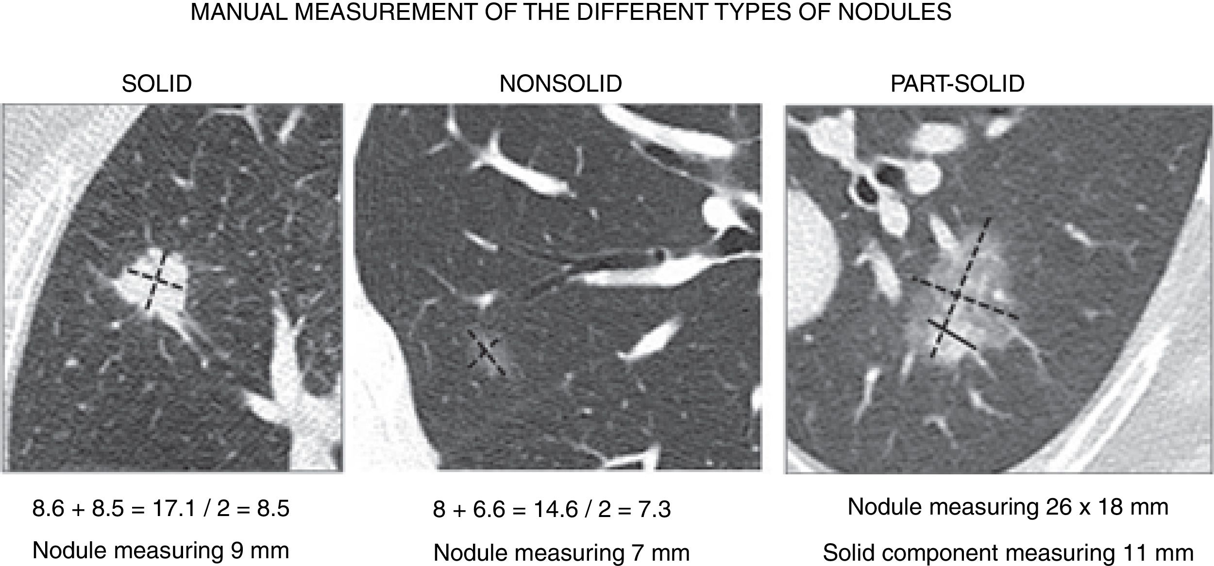 Incidental pulmonary nodules Characterization and management