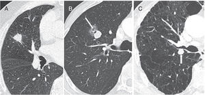 Nodules with a high risk for malignancy. (A) A 70-year-old man with a solid nodule with spiculated margins in the right upper lobe. (B) Part-solid nodule with signs of pseudocavitation (arrow). (C) An 85-year-old man with extensive emphysema and solid nodule with lobulated margins in the left upper lobe (arrow). In all three cases, biopsy was indicated. In (A) and (C), the diagnosis was squamous cell carcinoma, and in (B) invasive adenocarcinoma was diagnosed.