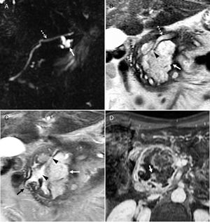 Intraductal papillary mucinous neoplasm of the pancreas. (A) A 76-year-old woman with branch duct papillary mucinous neoplasm. T2-weighted image of the bile duct showing a lobulated cystic lesion (arrow) in communication with the pancreatic duct (dotted arrow). The lesion has remained stable after several years of follow-up. (B–D) Mixed-type intraductal papillary mucinous neoplasm, of the main and branch duct. T2-weighted coronal image (B) showing dilatation of the main duct (dotted arrow) and a large cystic lesion (arrow) in communication with the duct (arrowhead). T2-weighted coronal image (C) showing the cystic mass (white arrow) in communication with the duct (arrowheads) and protrusion of the papilla towards the duodenum (black arrow). T1-weighted axial image (D) with contrast and fat suppression showing peripheral and heterogeneous enhancement of the lesion (arrow). This is a 58-year-old patient with mixed-type intraductal papillary mucinous neoplasm that was unresectable due to portal vein and hepatic artery infiltration. After chemoradiotherapy treatment, tumor volume decreased significantly, and mild atrophy of the rest of the pancreas was observed. Five years later, the mass remains stable and the patient is asymptomatic except for occasional episodes of anorexia.