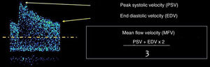 Flow parameters represented on a transcranial Doppler ultrasound.
