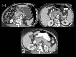 Examples of interstitial oedematous pancreatitis. (A) Increased size and poorly defined borders of the head of the pancreas (asterisk). (B) Another case with greater striation of the peripancreatic fat (short arrows) and minimally heterogeneous pancreatic enhancement caused by interstitial oedema. (C) Diffuse increase in size and homogeneous enhancement of the pancreas, a small acute peripancreatic fluid collection around the tail (long arrow).