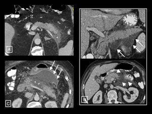 Necrotising pancreatitis. (A) Pancreatic necrosis: hypodensity of the tail of the pancreas with respect to the rest of the gland (asterisk) compatible with necrosis. (B) Peripancreatic necrosis: the pancreas presents full and homogeneous enhancement, but is surrounded by a partially encapsulated (long arrows) collection with heterogeneous content due to hypodense solid elements in fluid (short arrows) indicative of necrosis. (C) Pancreatic and peripancreatic necrosis: glandular necrosis (asterisks) and necrosis of the peripancreatic tissues forming a collection anterior to the pancreas (arrows).