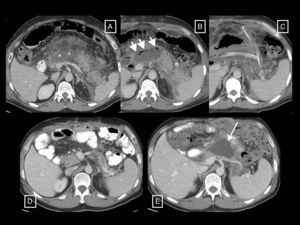 Post-debridement pseudocyst. Patient with necrotising pancreatitis who in the initial computed tomography (CT) (A) presented central necrosis of the pancreas (asterisks), later developing walled-off necrosis that was then superinfected (B, short arrows). The post-debridement CT (C) shows Martín Palanca catheters in the bed. Follow-ups over the following months (D) show resolution of the collection. However, 4 months after the debridement (E), the collection reoccurred (long arrow), filled with homogeneous fluid corresponding to pancreatic juices secreted by the viable tail due to disconnected pancreatic duct syndrome. This recurring collection is a post-debridement pseudocyst.