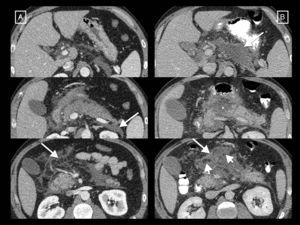 Example of how computed tomography (CT) performed too early can underestimate necrosis in acute pancreatitis. This CT study (image column A), performed on the day of onset of abdominal pain, showed a pancreas increased in size without areas suggestive of necrosis and with acute peripancreatic fluid collections (long arrows). The control performed 10 days later (image column B) clearly shows an area of glandular necrosis (asterisk) and increased collections, which are partially walled-off (long arrows) and contain fatty solid elements (short arrows) making them compatible with acute necrotic collections.