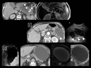 Examples of the greater tissue resolution of magnetic resonance imaging (MRI) and ultrasound in differentiating solid and fluid content of collections in acute pancreatitis. (A and B) Walled-off necrosis in two patients. In the first, the T2-weighted MRI shows better than the computed tomography (CT) that most of the collection is formed by the necrosed tail of the pancreas (asterisks). However, the greater sensitivity and specificity of CT with respect to MRI can be seen with regard to the small gas bubbles (short arrows), in this case secondary to a radiological catheter (long arrow). In the second, although the CT shows some dense solid foci in the interior (short arrow), the ultrasound shows them more clearly and in greater number (arrow heads). In this other patient (C; same as Fig. 3B) we can see from left to right the homogeneous appearance of a growing pseudocyst in the ultrasound, CT and T1- and T2-weighted MRI. In ultrasound, pseudocysts may show fine echos in their interior, but never clearly solid elements such as those in example (B(.