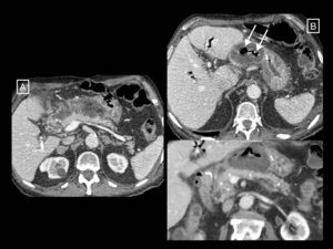 Infected peripancreatic necrosis. In the first study (A), signs of only peripancreatic necrotising pancreatitis can be seen in the form of a poorly defined heterogeneous collection anterior to the head and body of the pancreas compatible with an acute necrotic collection. In a follow-up performed due to fever after more than 4 weeks from the onset of symptoms (B), the collection is seen to be completely walled-off (walled-off necrosis) and gas bubbles (long arrows) compatible with superinfection have appeared. In the inferior coronal reconstruction, the normally enhanced pancreas can be seen (asterisks).