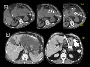 Two examples of necrotising pancreatitis that resolved with radiology-guided drainage alone. (A) In the first patient, from left to right, we can see a drainage tube inserted using the Seldinger technique with a classic approach via the left anterior pararenal space, first inserting the initial puncture needle inside the collection, passing a guidewire through it (short arrows) and, following the respective dilators (not shown), leaving in place a 12F catheter. (B) In the second patient we can see how a large walled-off necrosis was resolved thanks to radiology-guided drainage, in this case using a right anterior subcostal approach and a 14F tube.