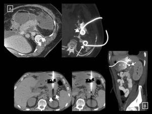Two further examples of necrotising pancreatitis that resolved with radiology-guided drainage alone. (A) In the first patient, a large necrotic collection can be seen, anteriorly surrounding the pancreas and extending into the left anterior pararenal space. A first more anterior and medial catheter was inserted in this (short arrow) but did not resolve the collection alone. Another posterior lateral catheter (long arrow) was therefore inserted later. The introduction of contrast through these catheters (image on right, axial oblique MRI reconstruction) showed that they were effectively draining interconnected areas, thereby creating a flushing system for the cavity, with one tube for the entry of saline and the other for drainage of the necrosis, which was eventually resolved. (B) Patient with clinical and analytical signs of infection and several walled-off necroses, one retrogastric (short arrows) on which it was decided to perform transgastric drainage. We can see the access to the collection via the stomach—lumen indicated with asterisks—and, in the later follow-up sagittal MRI reconstruction (in this case the gastric lumen is opacified with oral contrast), how the collection around the end of the tube has resolved (short arrow).