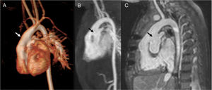A 6-month-old infant with dextro-transposition of the great arteries, bibanding of the pulmonary arteries and a large aortopulmonary window (arrows). These findings are clearly demonstrated on (A) volume rendering (VR) and (B) maximum intensity projection (MIP) reconstructions of the angio-MRI with contrast. The (C) WH3D sequence shows the same anatomical abnormality with greater spatial resolution.