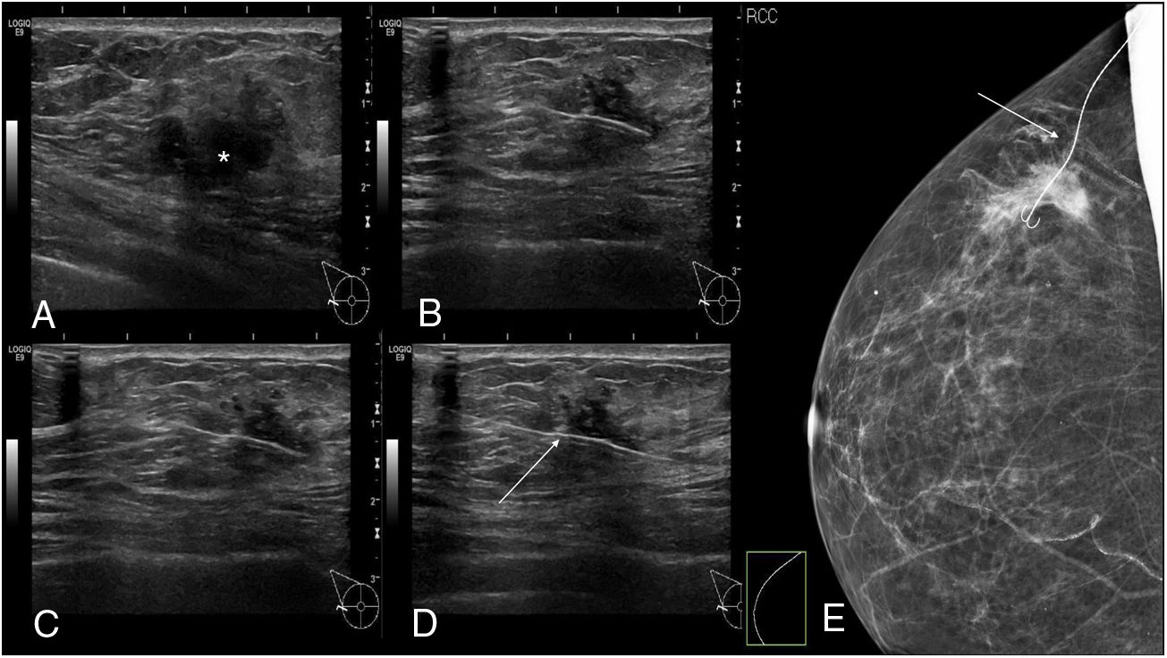 Cost-effectiveness of ultrasound-guided surgical clips placement for breast  cancer localization prior to neoadjuvant chemotherapy - ScienceDirect