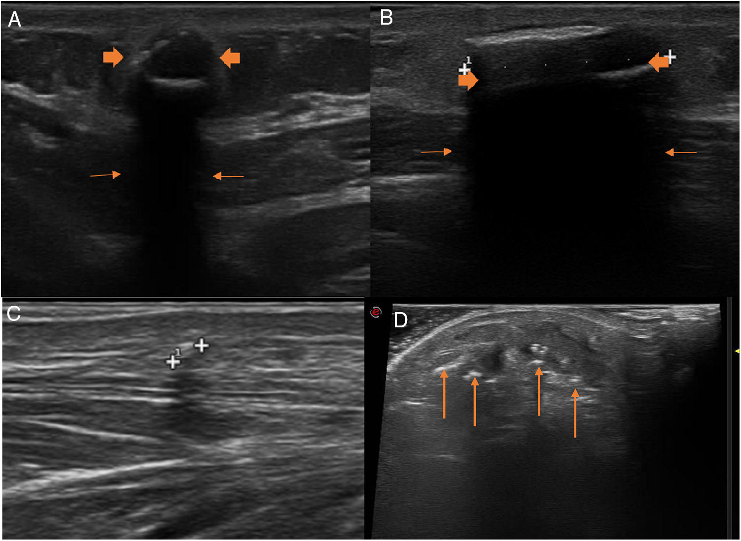 Ultrasonography of subcutaneous foreign bodies: differences depending ...